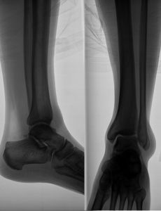 1002813_x-ray_image_of_the_leg.jpg