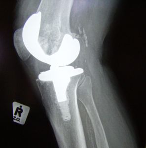 1183622_knee_replacement_-_side_view.jpg