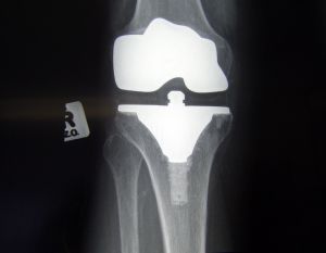 kneereplacementfrontview.jpg